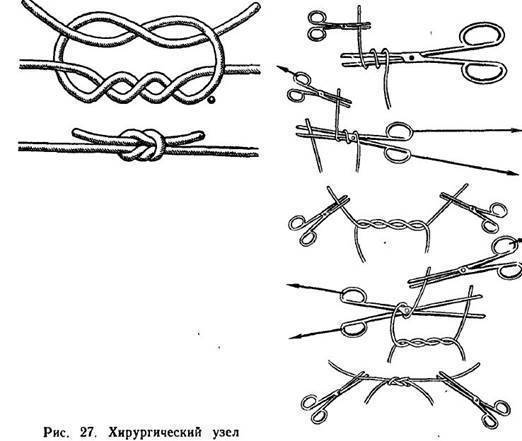 Хирургический узел: виды, использование, техника вязания