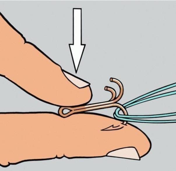 Как вытащить рыболовный крючок из пальца?
как вытащить рыболовный крючок из пальца?